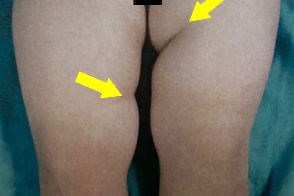 大腿皮膚溝の非対称
